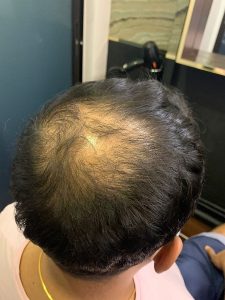 Hair Loss Specialist can help identify all hair loss issues