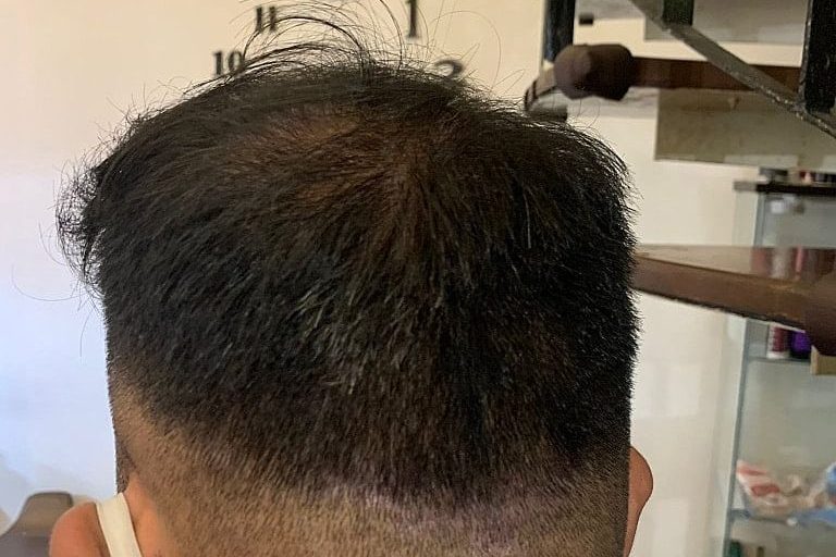 Men Hair Replacement Singapore