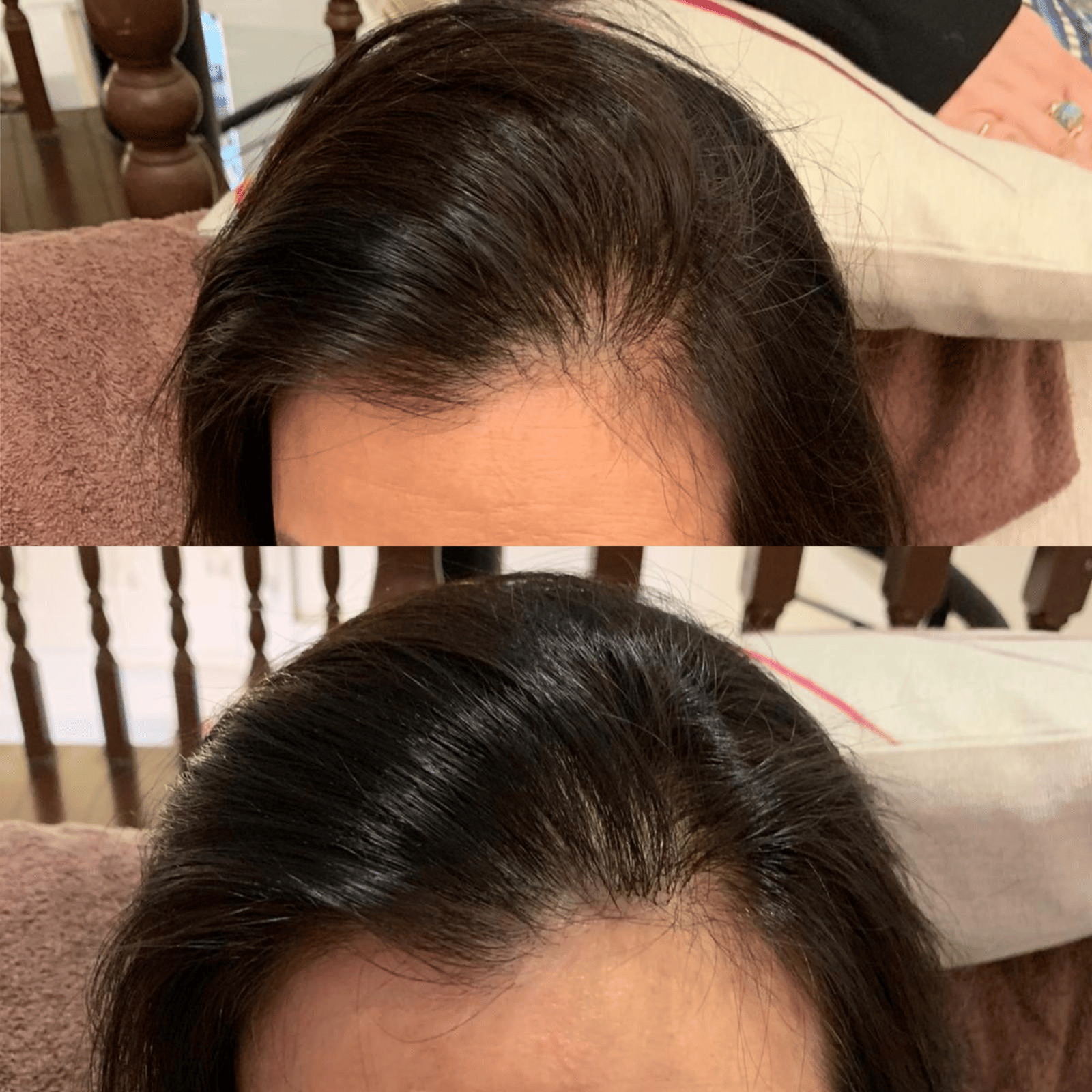 Explained: The Reasons Behind Female Pattern Hair Loss - Hair Care  Specialist | Hair Replacement & Hair Loss Treatment Singapore