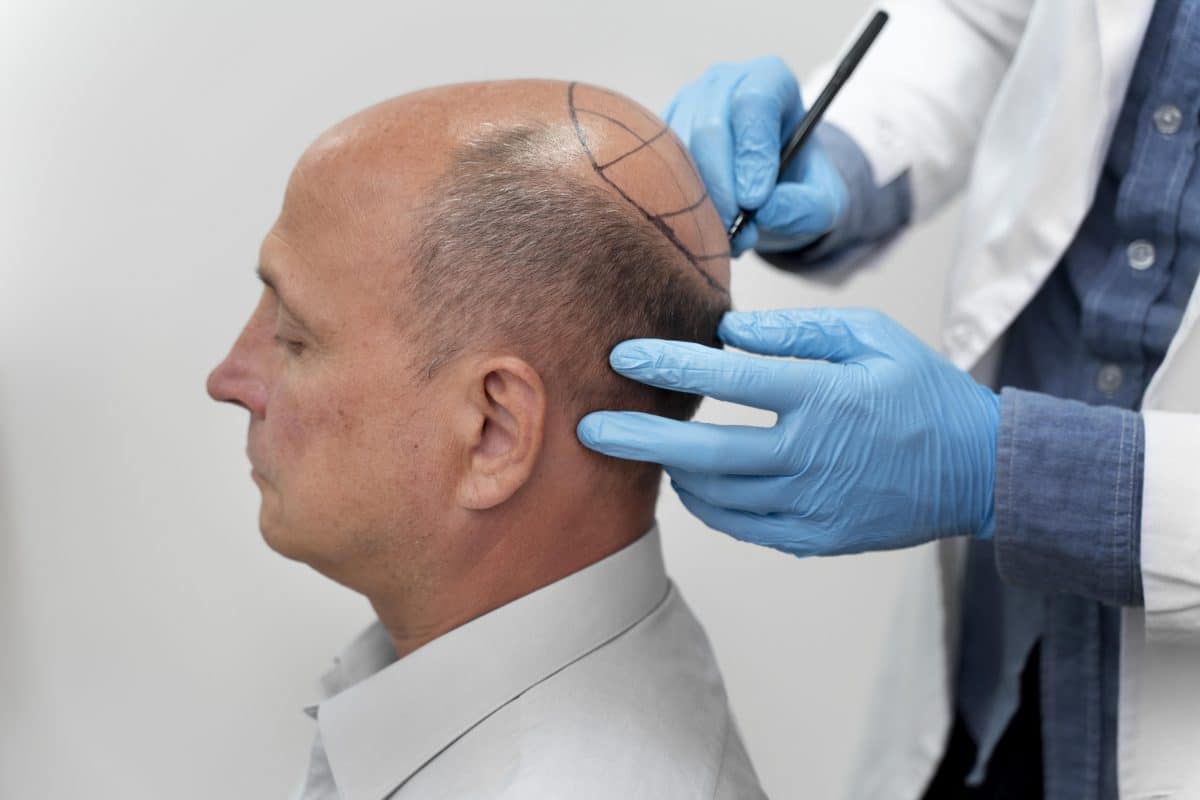 Hair Implant Cost Singapore